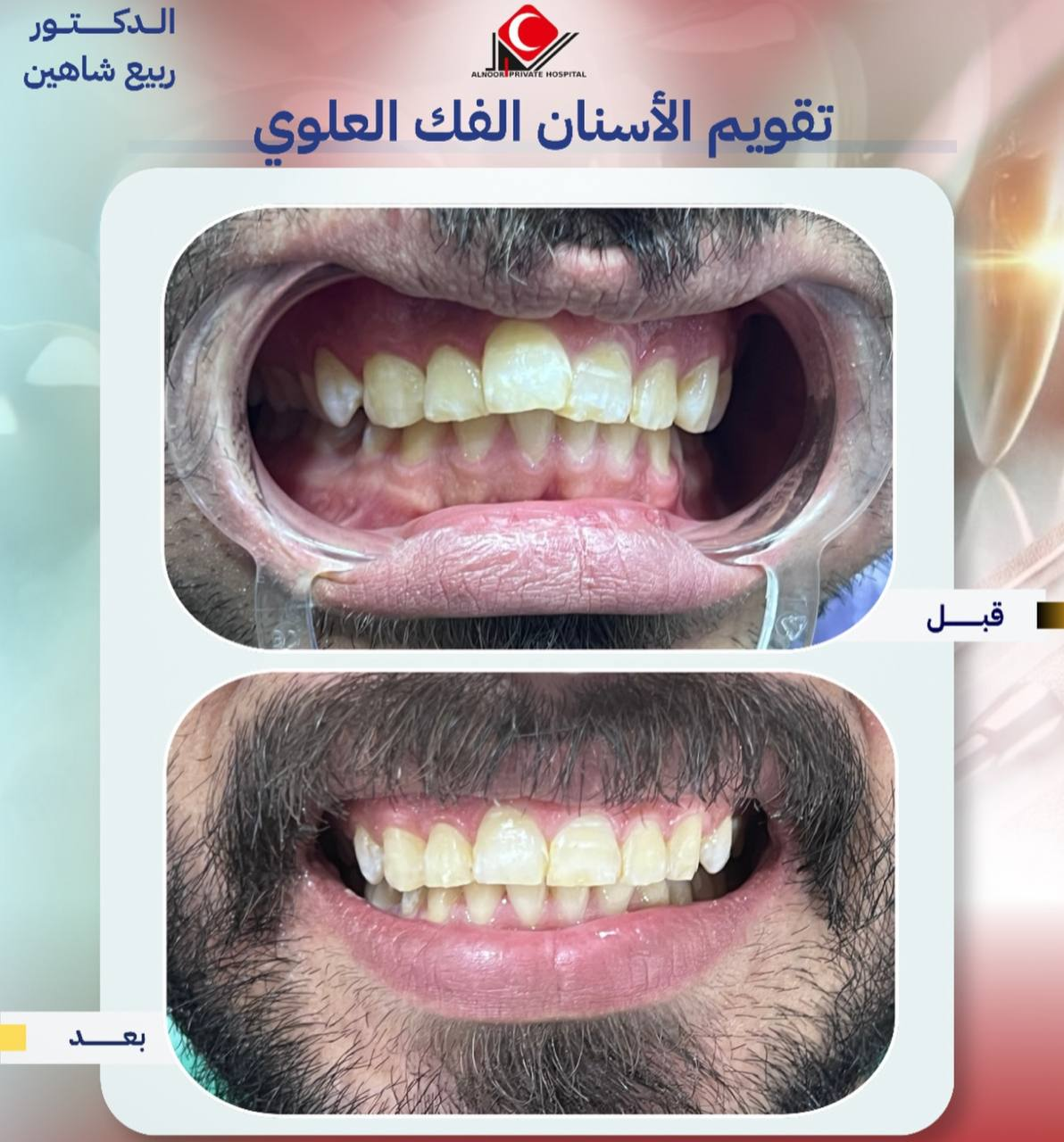 تقويم الأسنان